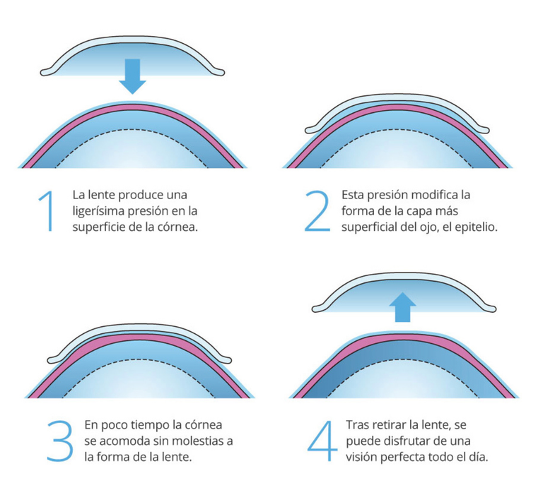 Ortoqueratologia Centro Optico Anton