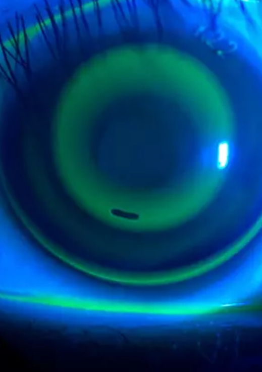 Ortoqueratologia Centro Optico Anton